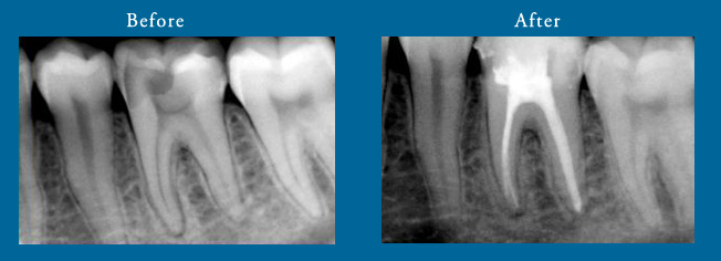 Root Canal X-ray